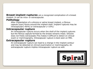Breast implant ruptures are a recognized complication of a breast
implant. It can be intra- or extracapsular.
Pathology
After implantation of a silicone or saline breast implant, a fibrous
capsule (scar) forms around the implant shell. Implant ruptures may be
intracapsular(~85%) or extracapsular (~15%) .
Intracapsular rupture
An intracapsular rupture occurs when the shell of the implant ruptures
but the fibrous capsule formed by the breast remains intact. Silicone
does not freely extravasate.This makes it difficult to detect on clinical
exam or mammography. Intracapsular rupture is best seen on MRI.
Extracapsular rupture
An extracapsular rupture can lead to a change in the implant contour
and may be detected on clinical examination or mammography. An
extracapsular rupture implies intracapsular rupture as well.
 