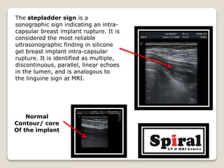 The stepladder sign is a
sonographic sign indicating an intra-
capsular breast implant rupture. It is
considered the most reliable
ultrasonographic finding in silicone
gel breast implant intra-capsular
rupture. It is identified as multiple,
discontinuous, parallel, linear echoes
in the lumen, and is analogous to
the linguine sign at MRI.
Normal
Contour/ core
Of the implant
 