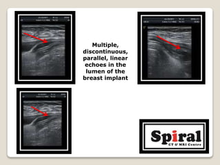 Multiple,
discontinuous,
parallel, linear
echoes in the
lumen of the
breast implant
 
