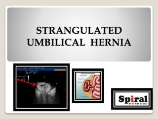 STRANGULATED
UMBILICAL HERNIA
 