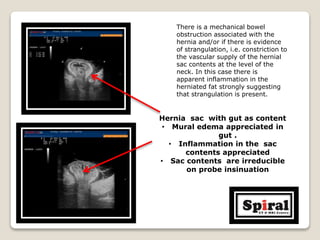 There is a mechanical bowel
obstruction associated with the
hernia and/or if there is evidence
of strangulation, i.e. constriction to
the vascular supply of the hernial
sac contents at the level of the
neck. In this case there is
apparent inflammation in the
herniated fat strongly suggesting
that strangulation is present.
Hernia sac with gut as content
• Mural edema appreciated in
gut .
• Inflammation in the sac
contents appreciated
• Sac contents are irreducible
on probe insinuation
 