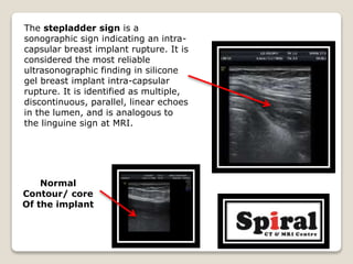 The stepladder sign is a
sonographic sign indicating an intra-
capsular breast implant rupture. It is
considered the most ...