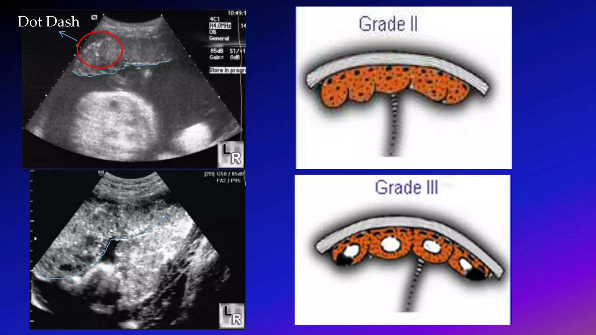 Ultrasound Imaging of Placenta | PPT