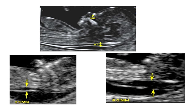 ultrasound in 1st TM.pdf