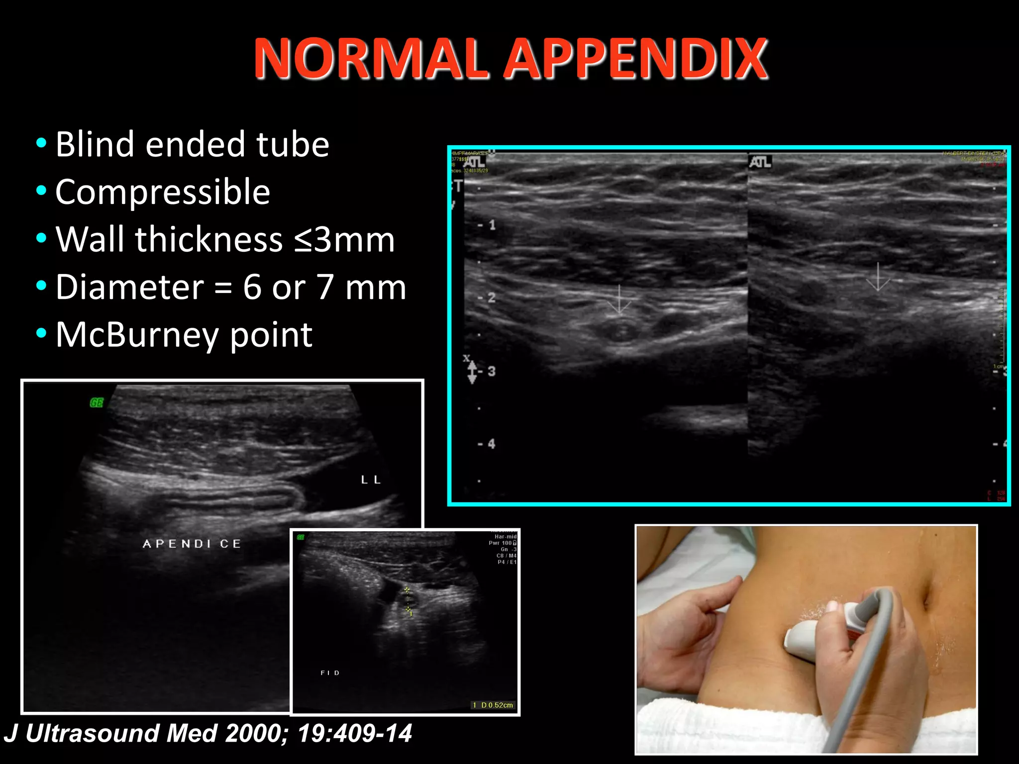 Appendix Tube Test Ultrasound in acute abdominal pain | PDF