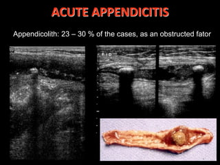 Ultrasound in acute abdominal pain | PDF