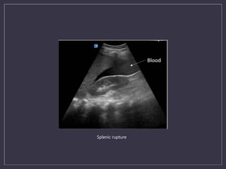 Splenic Rupture Us Ultrasound in cardiac arrest | PPTX