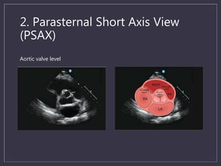 Ultrasound in cardiac arrest | PPTX