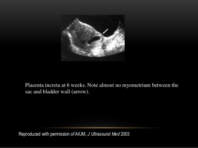 Ultrasound in diagnosis of placental invasion
