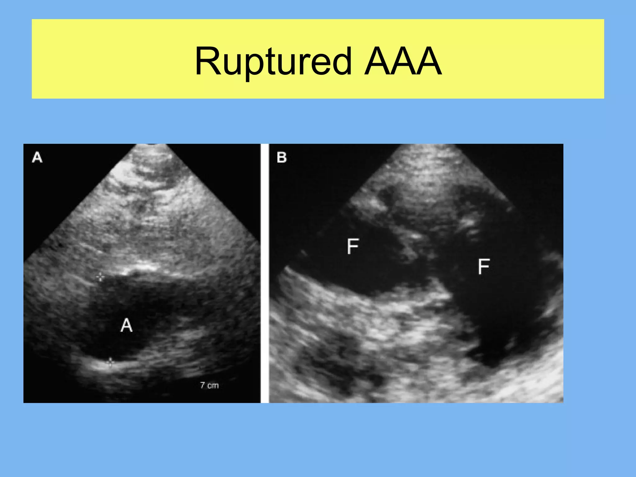 Ultrasound in abdominal emergencies | PPT