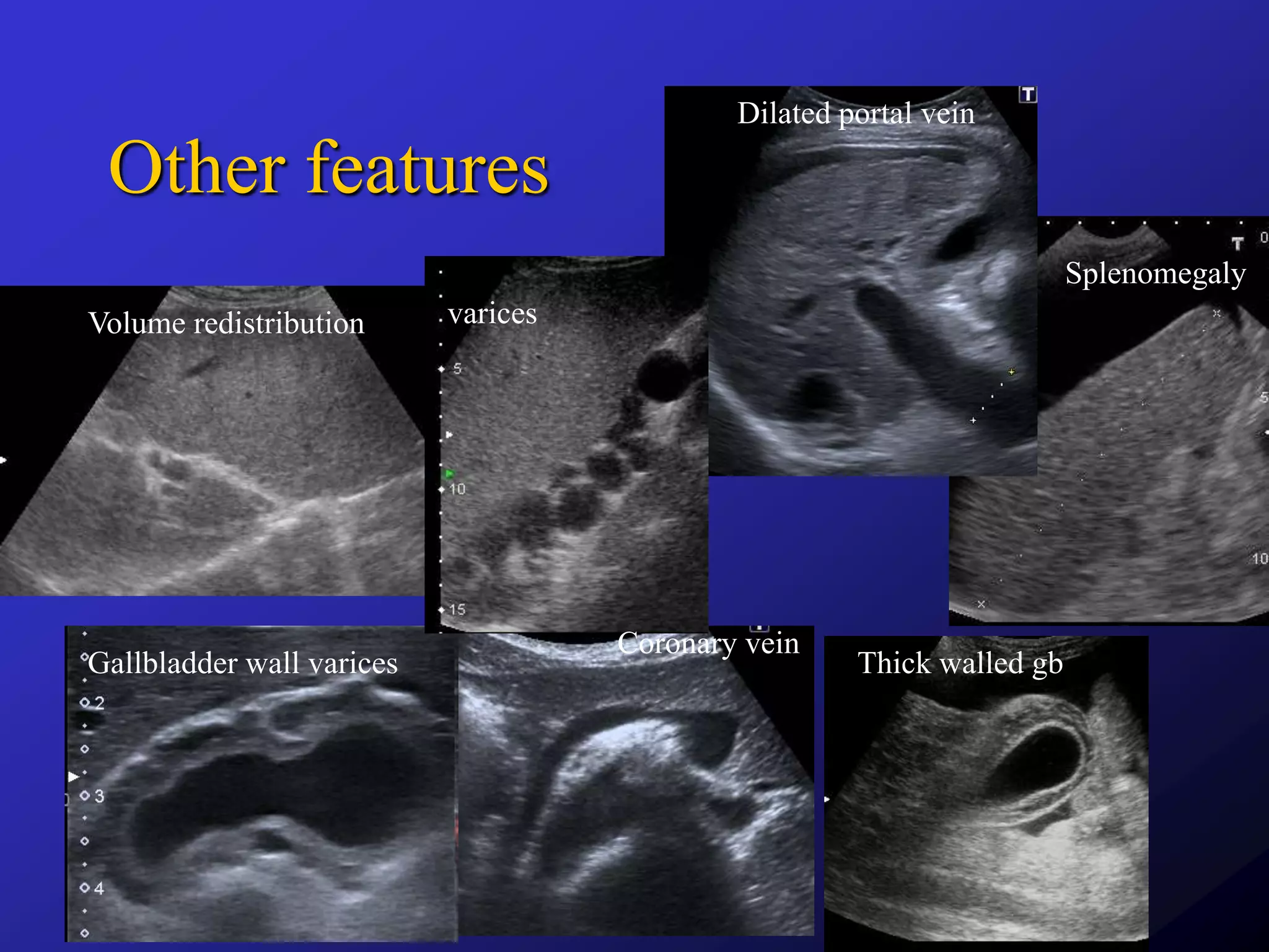 ultrasound-in-portal-hypertension-pptx