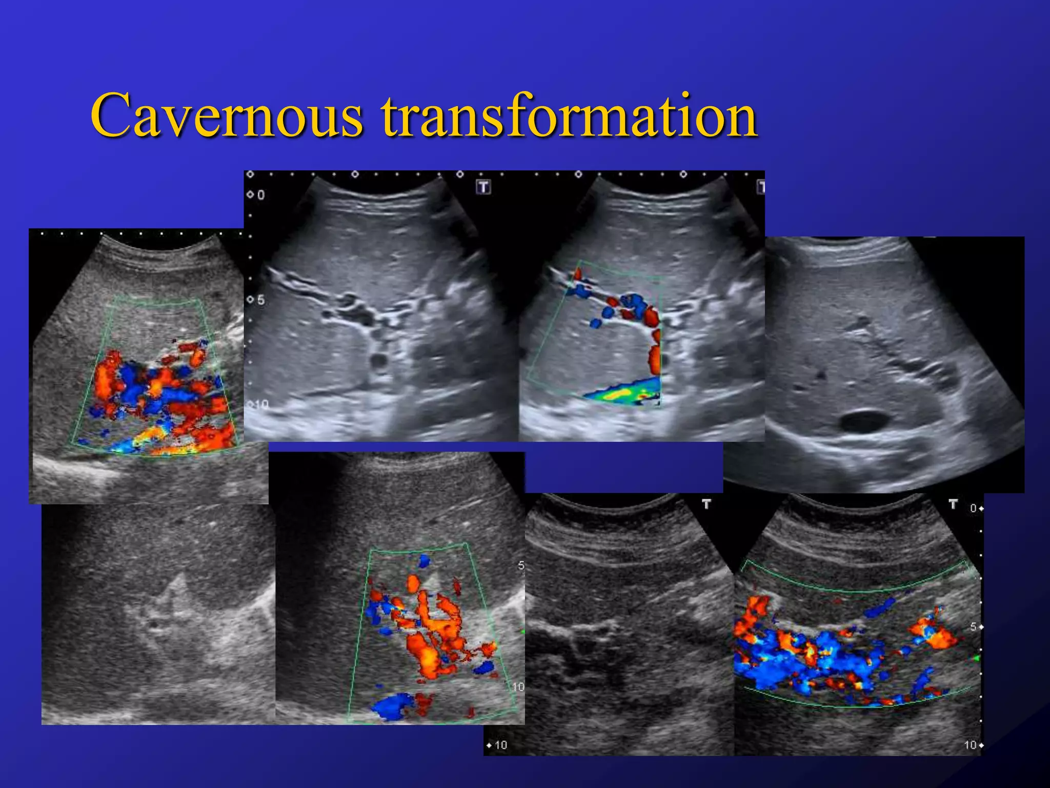Ultrasound In Portal Hypertension PPTX ultrasound-in-portal-hypertension-pptx