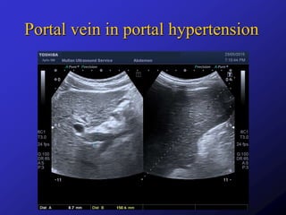 Ultrasound In Portal Hypertension PPTX ultrasound-in-portal-hypertension-pptx