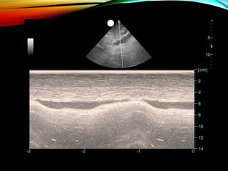Ultrasound in Shock | PPTX