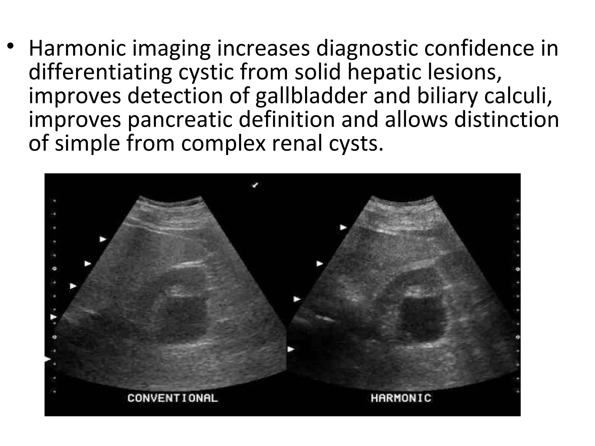 • Harmonic imaging increases diagnostic confidence in
differentiating cystic from solid hepatic lesions,
improves detection of gallbladder and biliary calculi,
improves pancreatic definition and allows distinction
of simple from complex renal cysts.
 