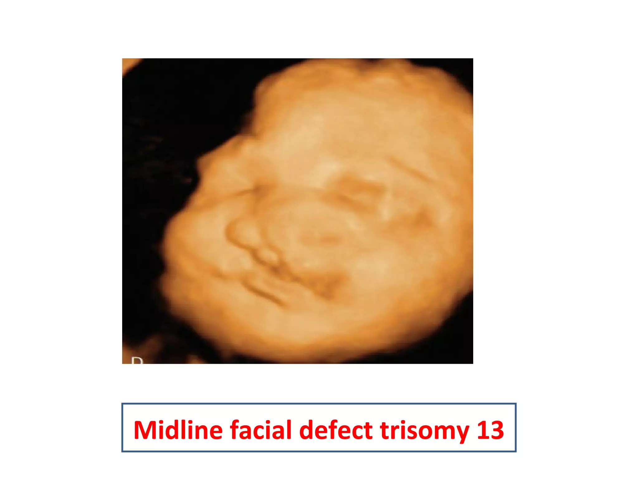 Midline facial defect trisomy 13
 