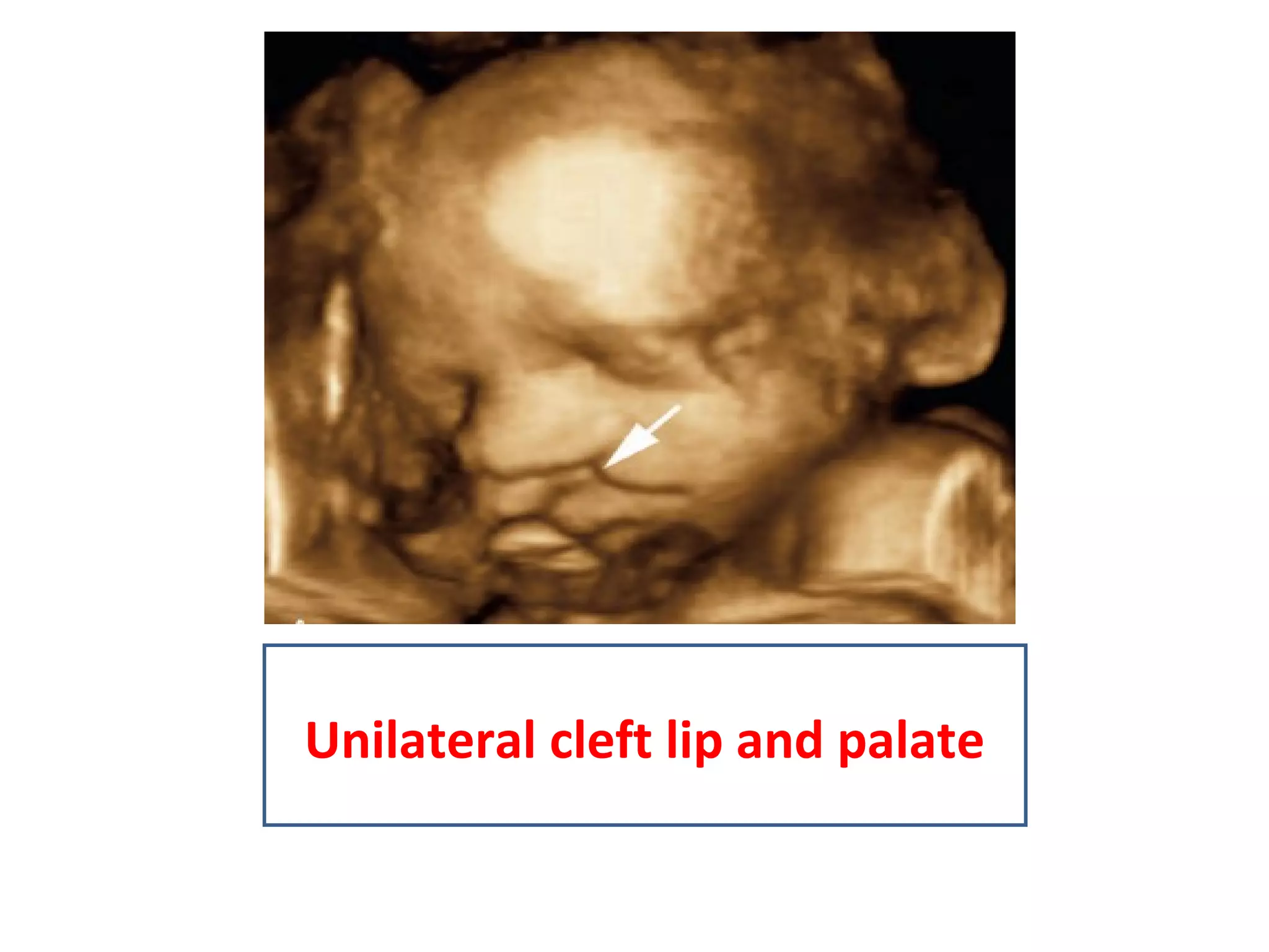 Unilateral cleft lip and palate
 