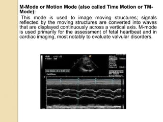 M-Mode or Motion Mode (also called Time Motion or TM-
Mode):
This mode is used to image moving structures; signals
reflected by the moving structures are converted into waves
that are displayed continuously across a vertical axis. M-mode
is used primarily for the assessment of fetal heartbeat and in
cardiac imaging, most notably to evaluate valvular disorders.
 