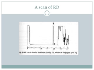 Peripheral Rdb Scan Ultrasound in Ophthalmology.pptx