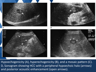 Ultrasound liver | PPTX