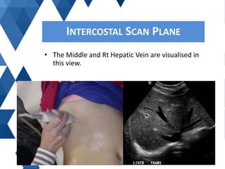 • The Middle and Rt Hepatic Vein are visualised in
this view.
INTERCOSTAL SCAN PLANE
 