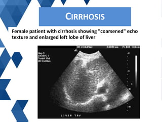 Female patient with cirrhosis showing "coarsened" echo
texture and enlarged left lobe of liver
CIRRHOSISCIRRHOSIS
 