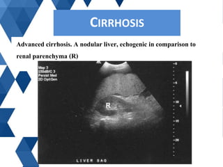 Advanced cirrhosis. A nodular liver, echogenic in comparison to
renal parenchyma (R)
CIRRHOSISCIRRHOSIS
 