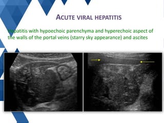 ACUTE VIRAL HEPATITIS
Hepatitis with hypoechoic parenchyma and hyperechoic aspect of
the walls of the portal veins (starry...