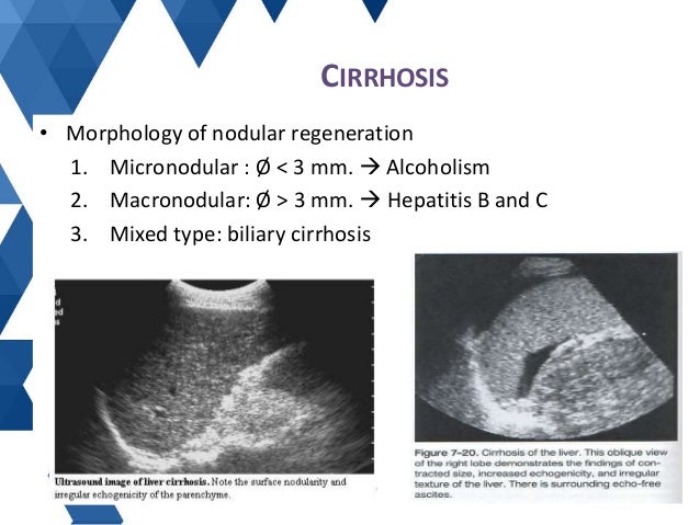 Cirrhosis Liver Ultrasound