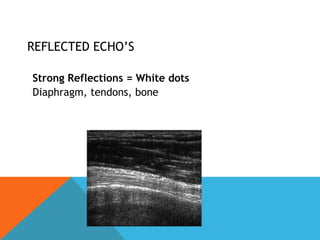 REFLECTED ECHO’S
No Reflections = Black dots
• Fluid within a cyst, urine, blood
• Echofree.
 