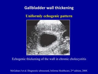 Gallbladder wall thickening
Uniformly echogenic pattern
Echogenic thickening of the wall in chronic cholecystitis
McGahan ...