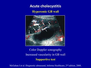 Acute cholecystitis
Hyperemic GB wall
McGahan J et al. Diagnostic ultrasound, Informa Healthcare, 2nd edition, 2008.
Color...