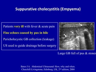cholecystitis chronic ultrasound
