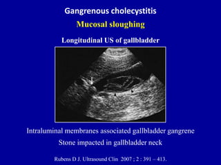 Gangrenous cholecystitis
Mucosal sloughing
Rubens D J. Ultrasound Clin 2007 ; 2 : 391 – 413.
Longitudinal US of gallbladde...