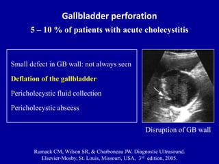 Chronic Cholecystitis Ultrasound Wes Sign