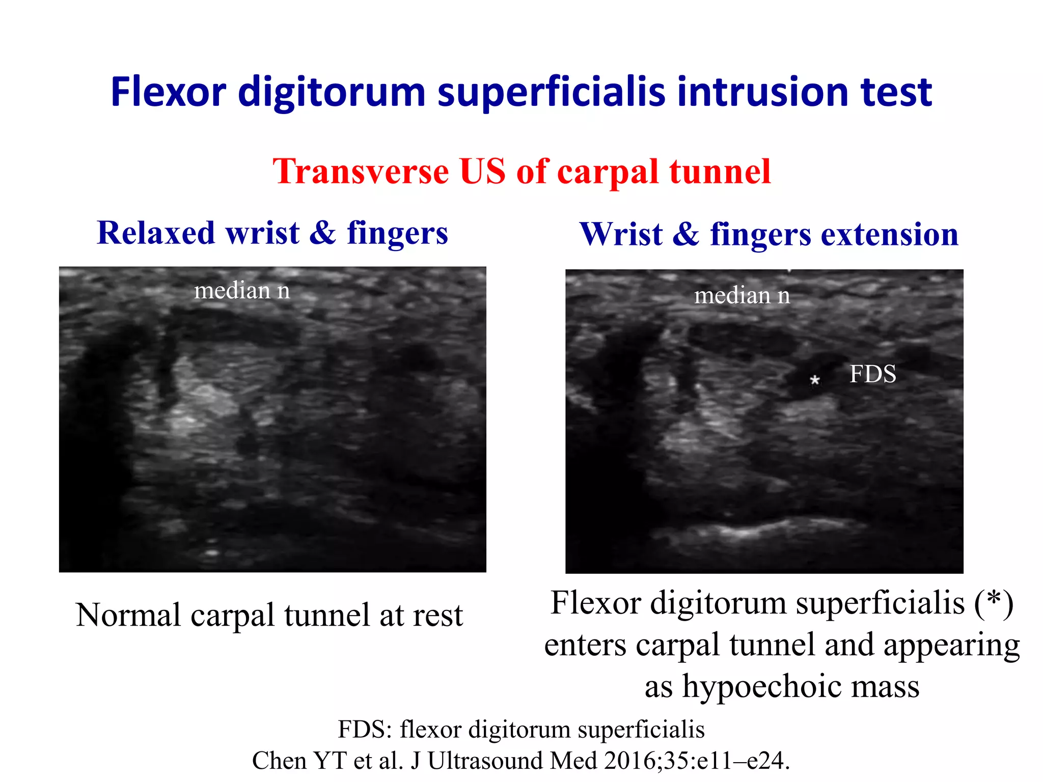Ultrasound of carpal tunnel syndrome | PPTX