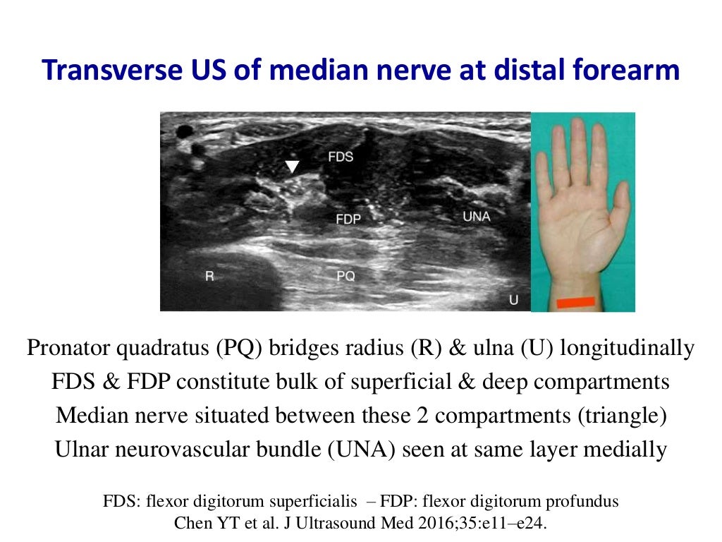 Ultrasound of carpal tunnel syndrome