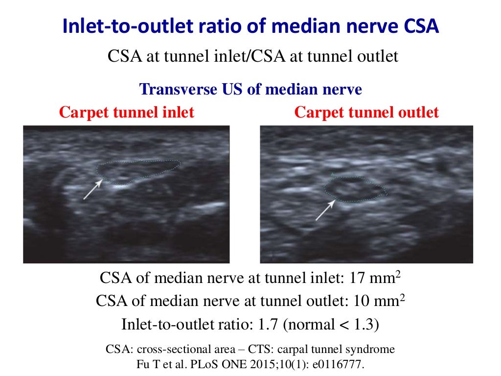 Ultrasound of carpal tunnel syndrome