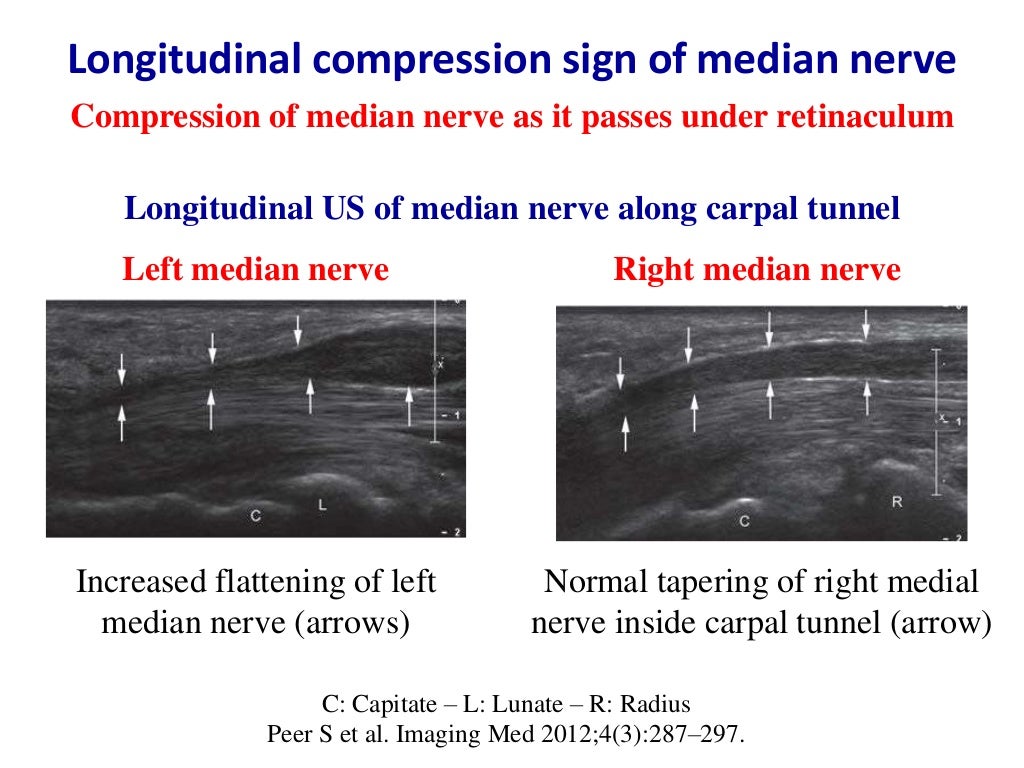 Ultrasound of carpal tunnel syndrome