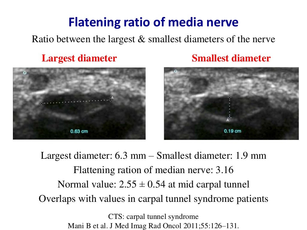 Ultrasound of carpal tunnel syndrome