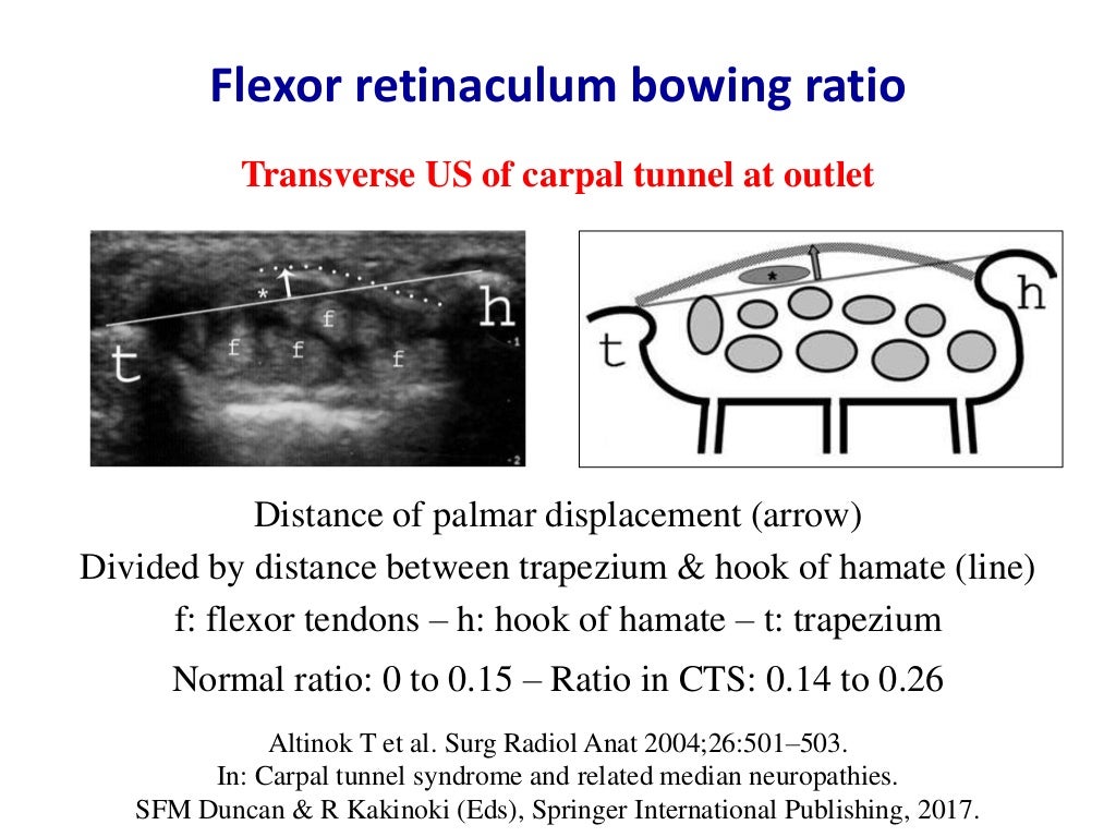 Ultrasound of carpal tunnel syndrome