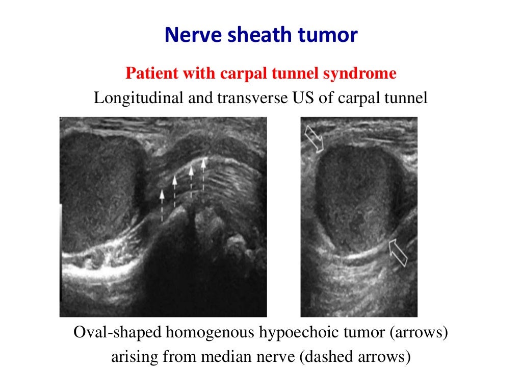 Ultrasound of carpal tunnel syndrome