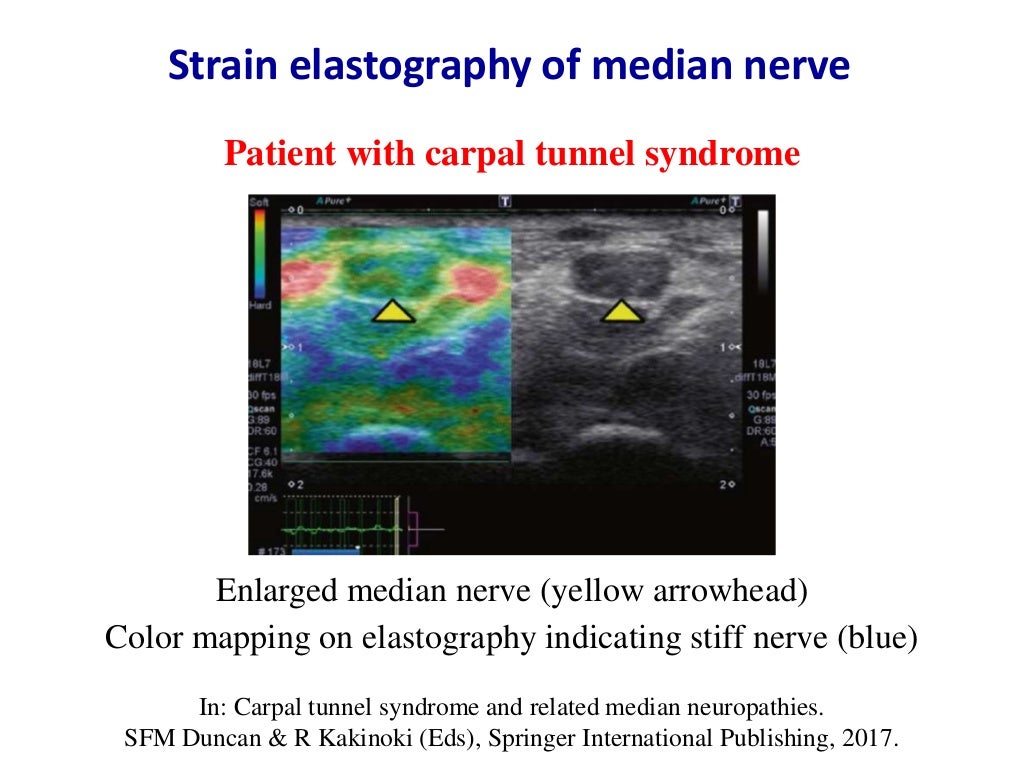 Ultrasound of carpal tunnel syndrome
