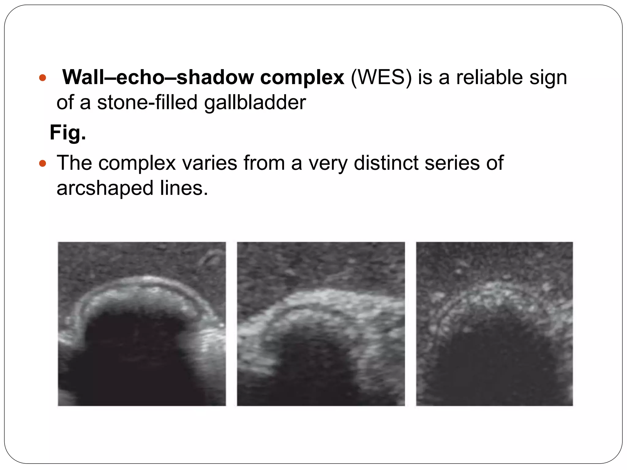Ultrasound of gall bladder | PPTX