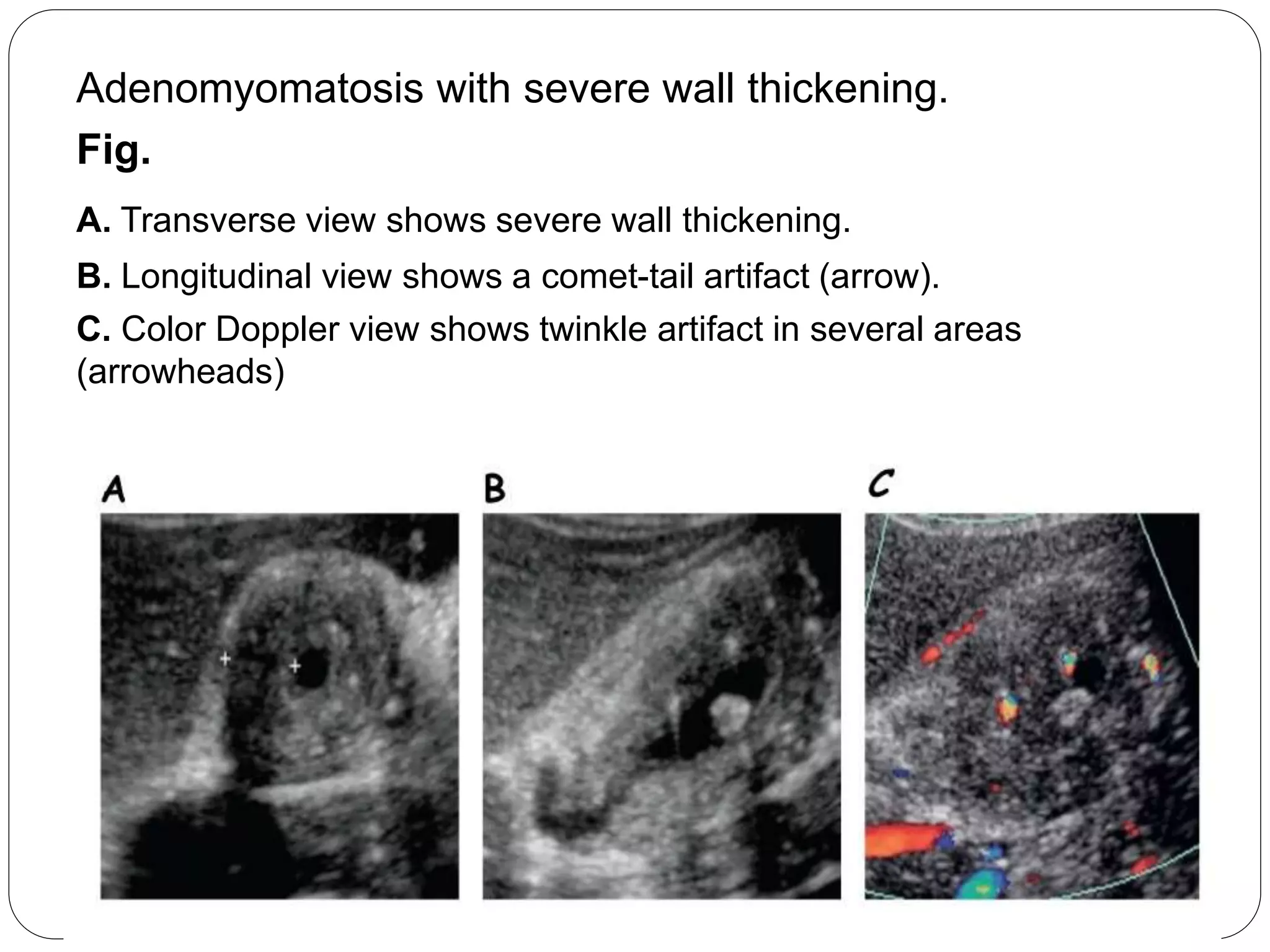 ultrasound-of-gall-bladder-pptx