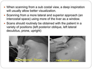 Interpostal Scanning Ultrasound of gall bladder | PPTX