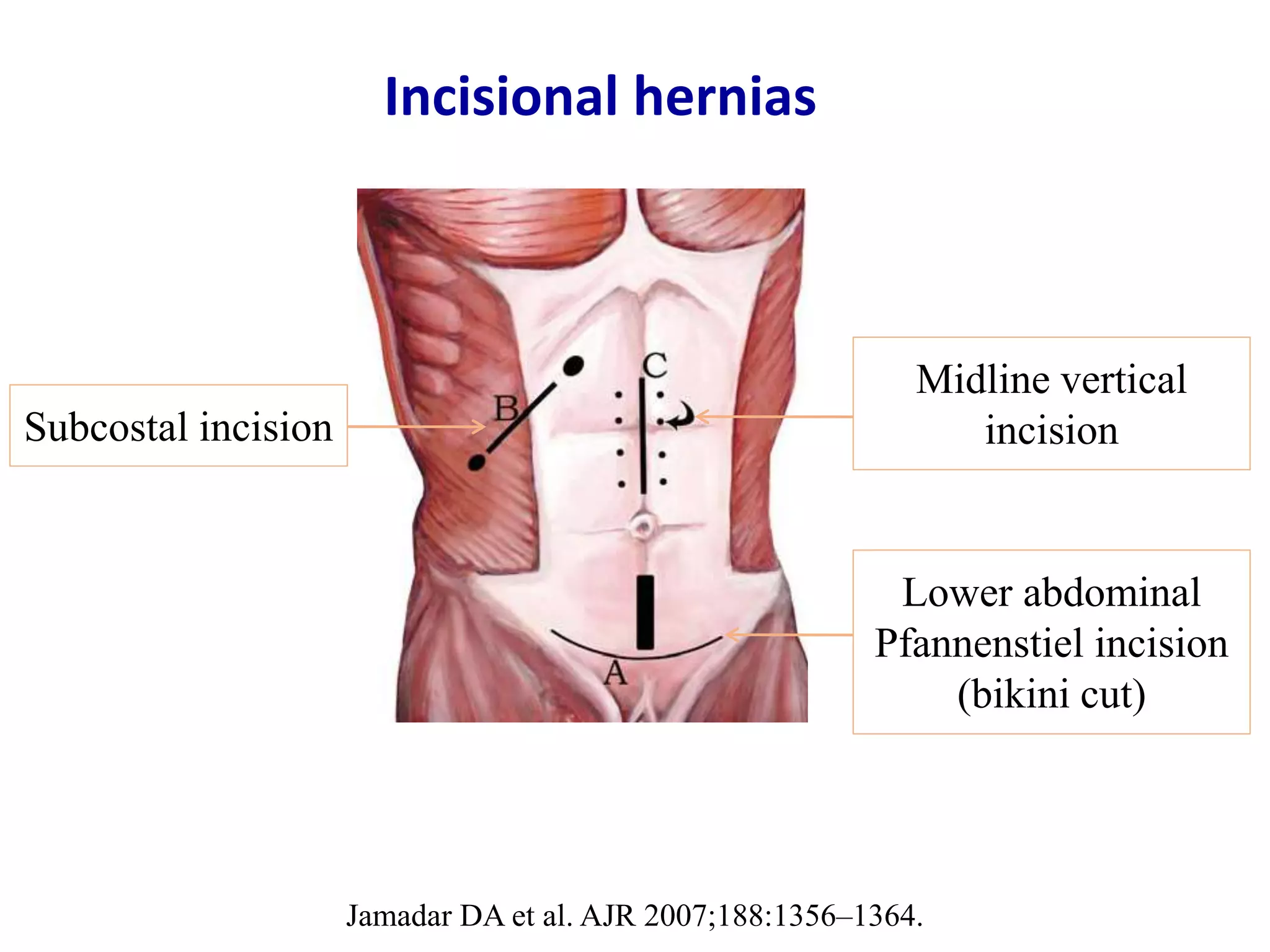 Ultrasound of groin & anterior abdominal wall hernias | PPTX
