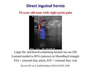 Groan Fat Ultrasound of groin & anterior abdominal wall hernias | PPTX
