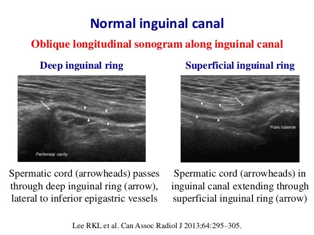 Ultrasound of groin & anterior abdominal wall hernias