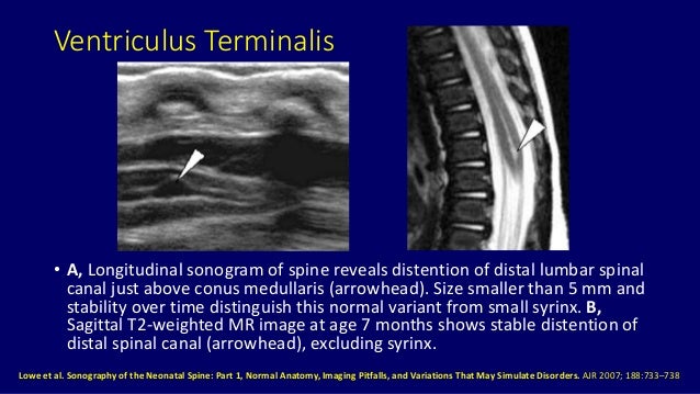 Ultrasound of spinal cord in neonates Dr. Muhammad Bin Zulfiqar